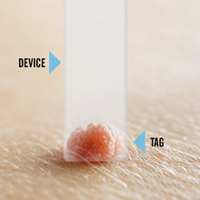 Load image into Gallery viewer, Tagcure - Skin Tag Removal Device