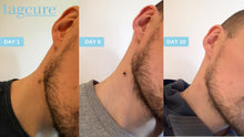 Load image into Gallery viewer, Tagcure - Skin Tag Removal Device