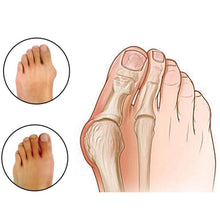 Load image into Gallery viewer, Glamza Splint Corrector Device