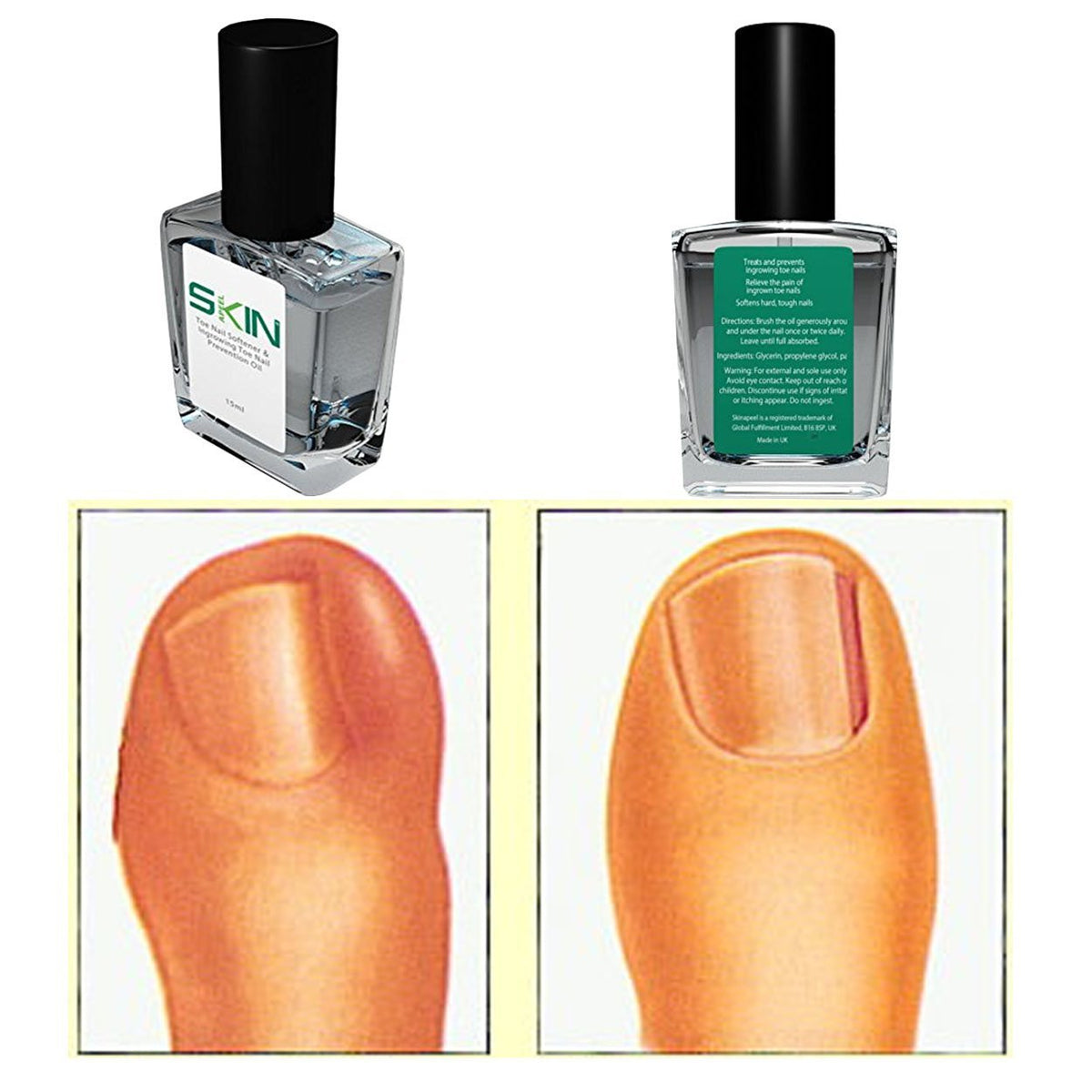 Skinapeel Toe Nail Softener and Ingrowing Toenail Prevention Oil ...